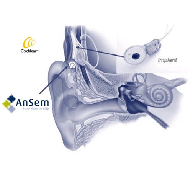 ansem_implant