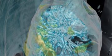 הדמיה של פגיעת נגיף הקורונה בריאות. צילום: Surgical Theater